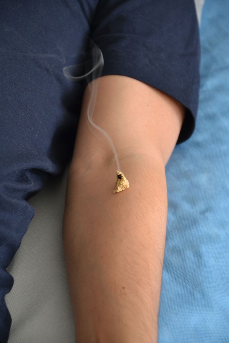 Moxibustion-Behandlung: Moxa-Kegel auf Akupunkturpunkt, leichter Rauch sichtbar